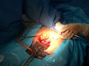 cirugía mioma geinecológico