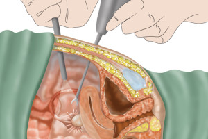 endometriosis ciruía laser